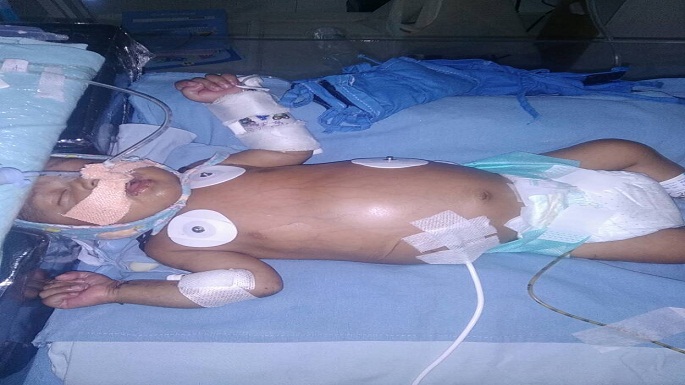 bhopal 2 month old child heart treatment