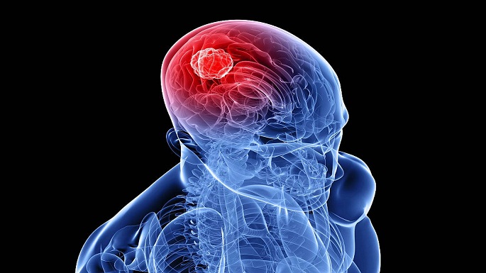 brain tumor