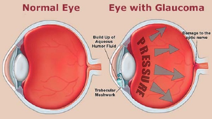 glaucoma problem