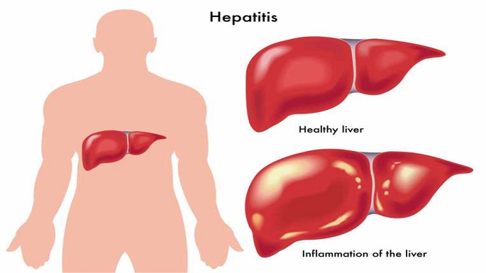 hepatitis-b