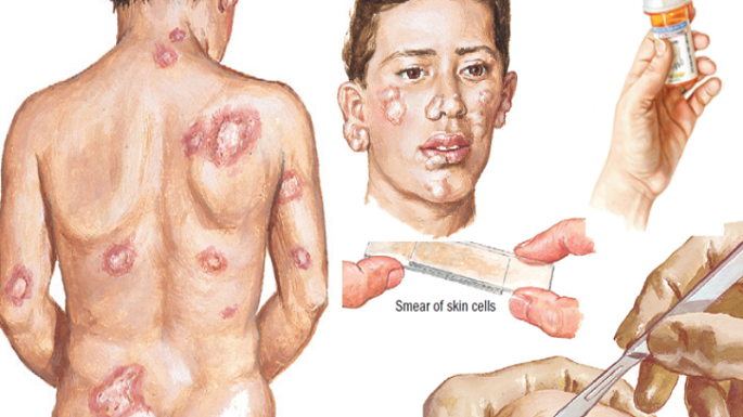 leprosy and skin diseases