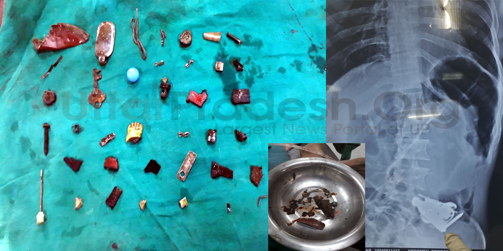 man eat Iron nails key behest of Tantrik doctors saved life in hardoi