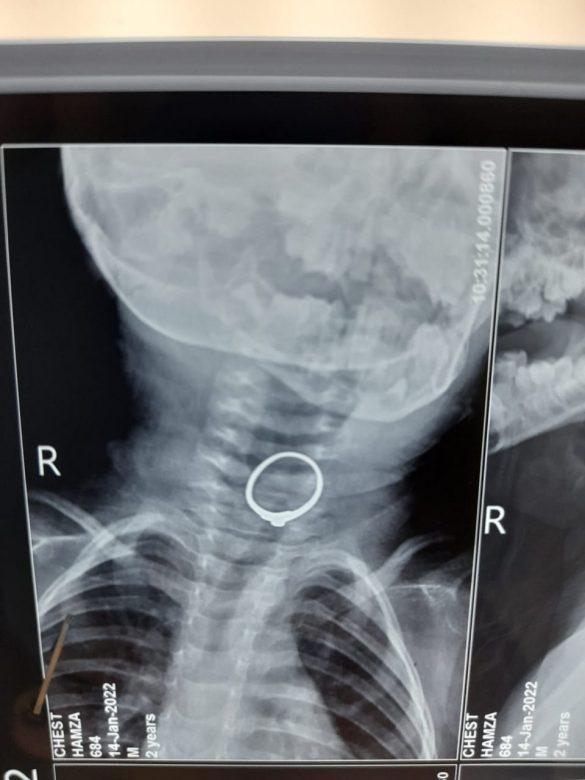 two-year-old-girl-swallowed-the-ring-got-stuck-in-the-throat-doctors-saved-her-life3